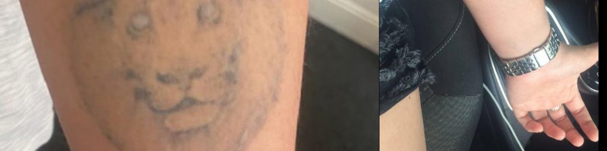 Tattoo Removal Manchester